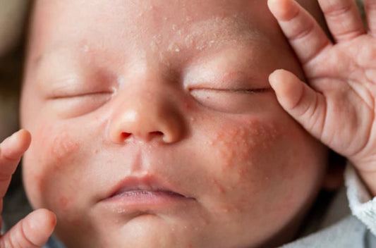 Best Fabrics for Babies with Eczema (What to Avoid + What to Choose)