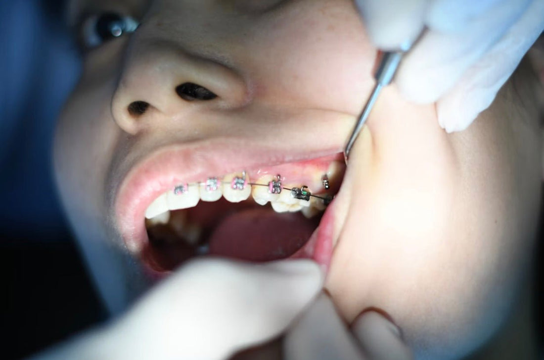 Signs Your Child May Need Braces Earlier Than You Think