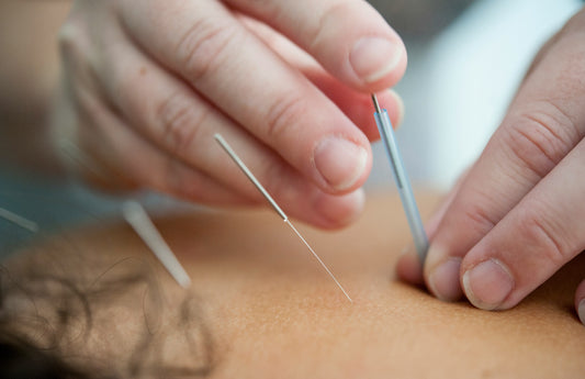 What is acupuncture?
