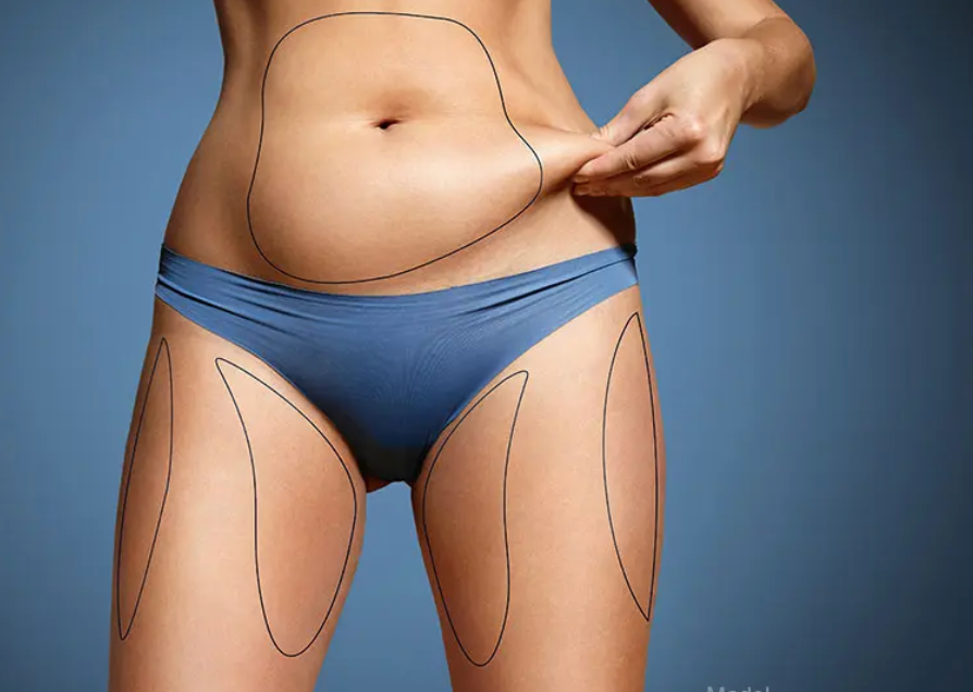 What to Expect From a Professional Liposculpture Procedure